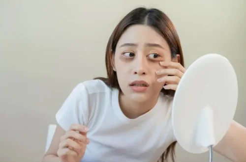 How to Treat Panda Eyes Easily